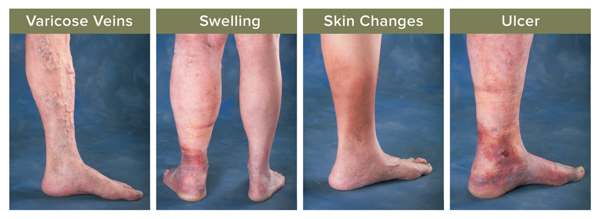 Four images of legs that have four major vein conditions: vericose veings, swelling, skin changes, and ulcer
